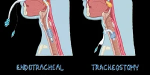 Mechanical Ventilation