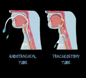Mechanical Ventilation