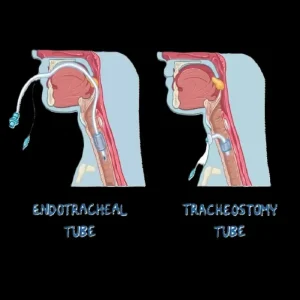 Mechanical Ventilation